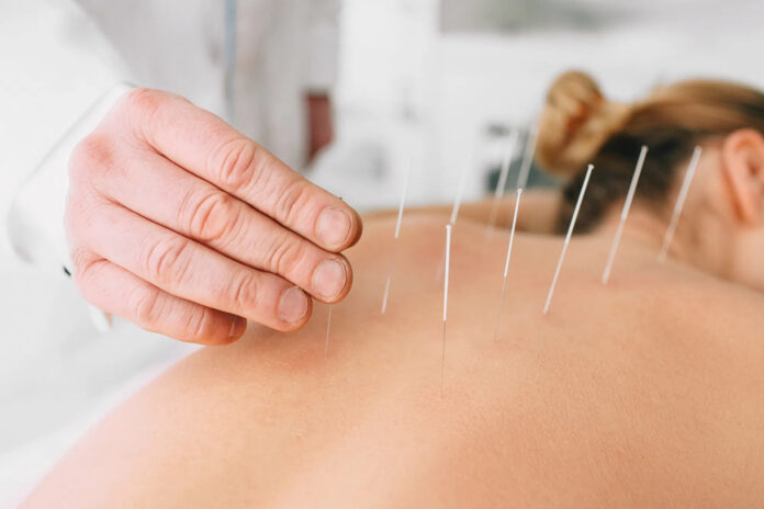 dry needling melbourne, dry needling physio melbourne