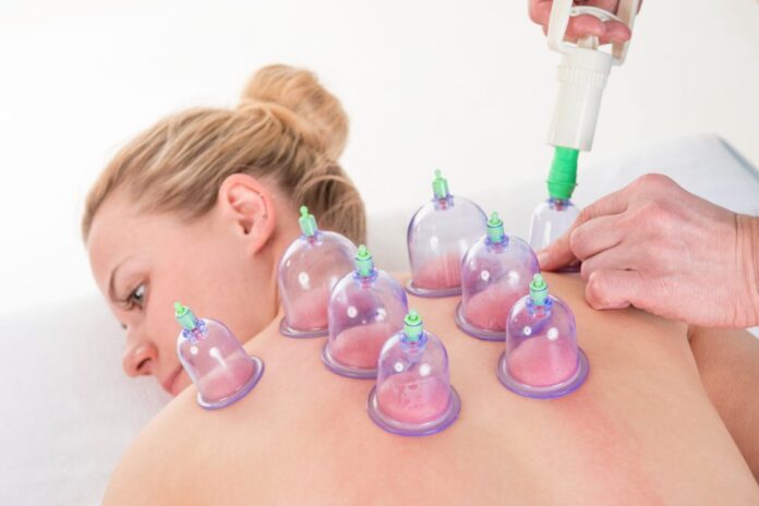 cupping therapy melbourne, cupping treatment melbourne