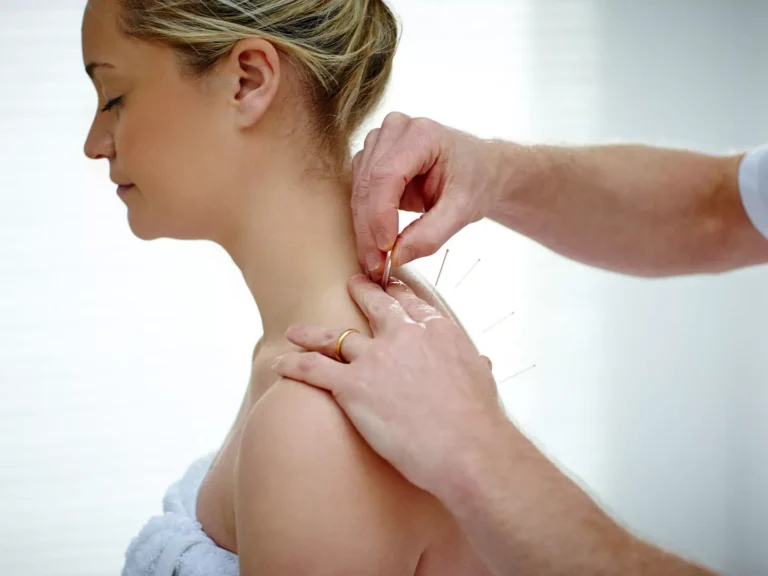 dry needling Melbourne