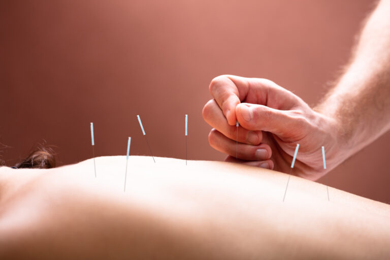 Dry needling Melbourne